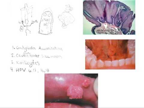Emberi papillomavírus fertőzés tünetei