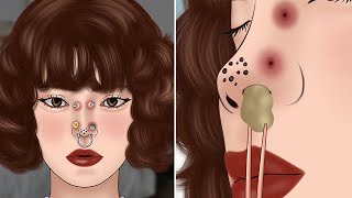 ASMR How To Get Rid Of ASMR Remove unmanaged piercing pus | Squeeze nose blackhead
