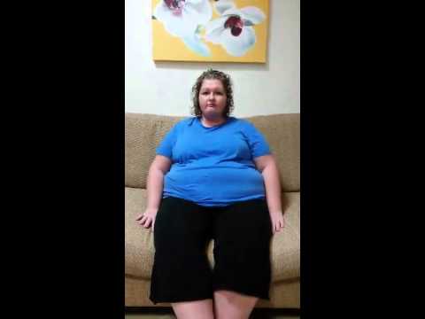 Bariatric Convertion from Gastric band to Duodenal Switch