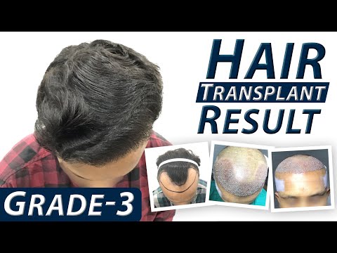 Hair Transplant Implanter-FUE Technique Result || 3270 Grafts, Grade-3 baldness ||HFHG India