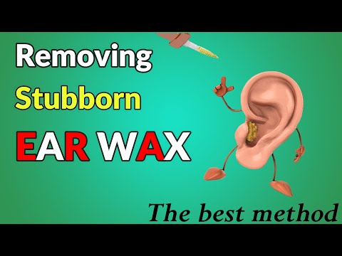 EAR WAX REMOVAL | The SAFEST and MOST EFFECTIVE Way To Get Rid Of STUBBORN Ear Wax At Home