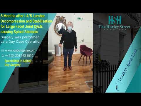 6 Months after L4/5 Lumbar Decompression and Stabilisation for Large Facet Joint Cysts