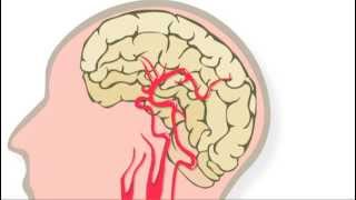 Trombolyse: behandeling na een herseninfarct