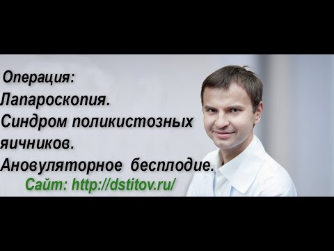 Видео Лапароскопия в лечении женского бесплодия