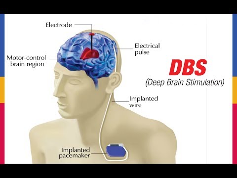 image-Can you have DBS if you have a pacemaker?