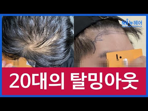 20대의 탈밍아웃! 모발이식? 미녹시딜?  l 우리끼리 탈밍아웃 l 뉴헤어