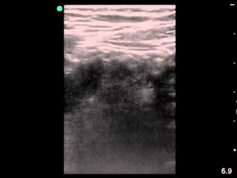 RLQ Pain in 9 year old Male with Appendicolith on PoCUS