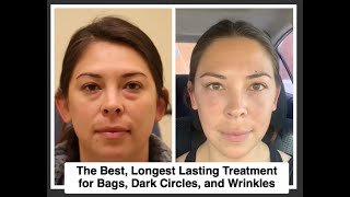The BEST, longest lasting treatment for bags, dark circles, and wrinkles