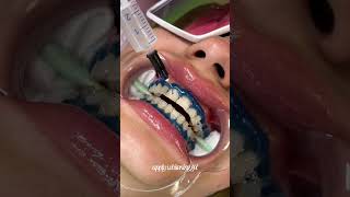 teeth whitening process 🦷 #teethwhitening#teethwhiteningprocedure