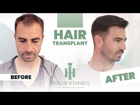 The Results of Hair Transplant Surgery After One Year