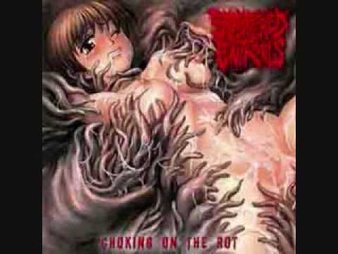 Omental Hernia Into the Scrotum - Splattered Entrails