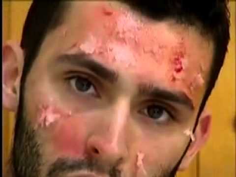 Leliminazione di pigmentary individua Rostov su Don Il perossido di idrogeno da pigmentary nota su mani
