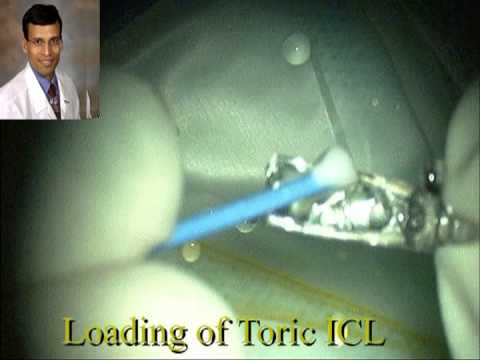 Visian Toric ICL With CentraFLOW Technology