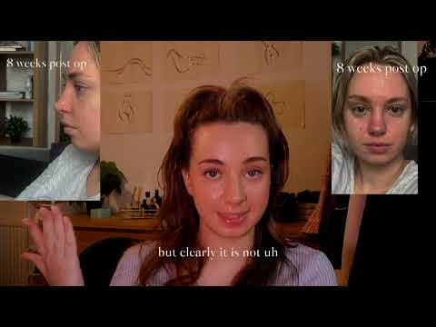 Rhinoplasty Swelling: 0-8 months update (MUST WATCH)