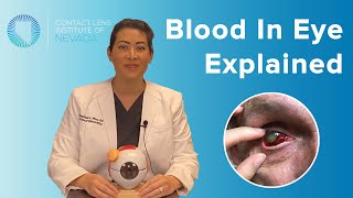 Subconjunctival Hemorrhage (Blood In Eye) Explained: Causes & Treatments