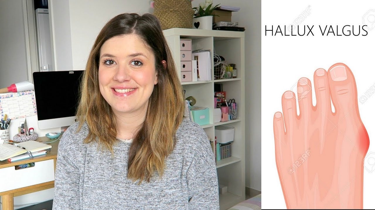 3 ANS APRÈS | Mon opération du pied : hallux valgus & rigidus