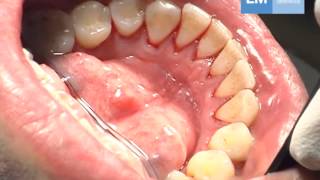 Periodontal treatment protocol