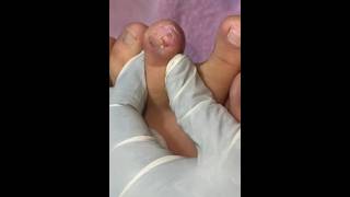 Ep_8655 Big ingrown toenail removal 👣 ผมไม่ไหวแล้ว..ต้องรีบมาหาพี่ครับ 🙂 (clip from Thailand)
