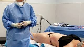 The GruBer BOOTY! Lipo Only Buttock Lift