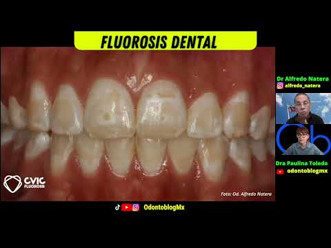 Tratamiento de la FLUOROSIS DENTAL