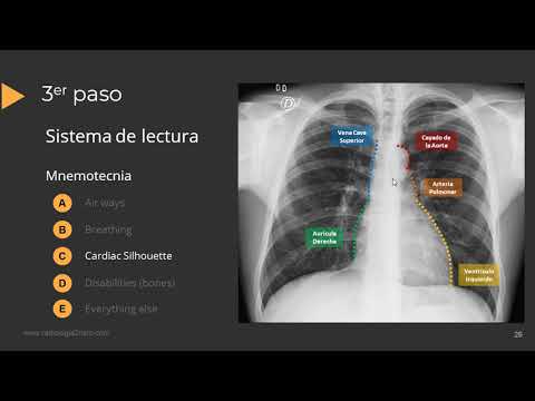 Guide to interpreting a chest X-ray