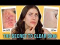 5 Ways Estheticians Treat Acne Acne Certification With Face Reality Acne Clinic