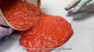 Silicone Injections Removal (Closed Technique) - Black Market Injections Get Surgically Removed