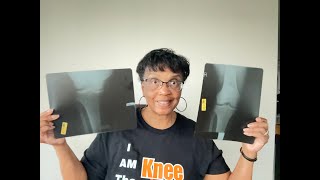Multiple X Rays -  Still In Knee Pain Watch This