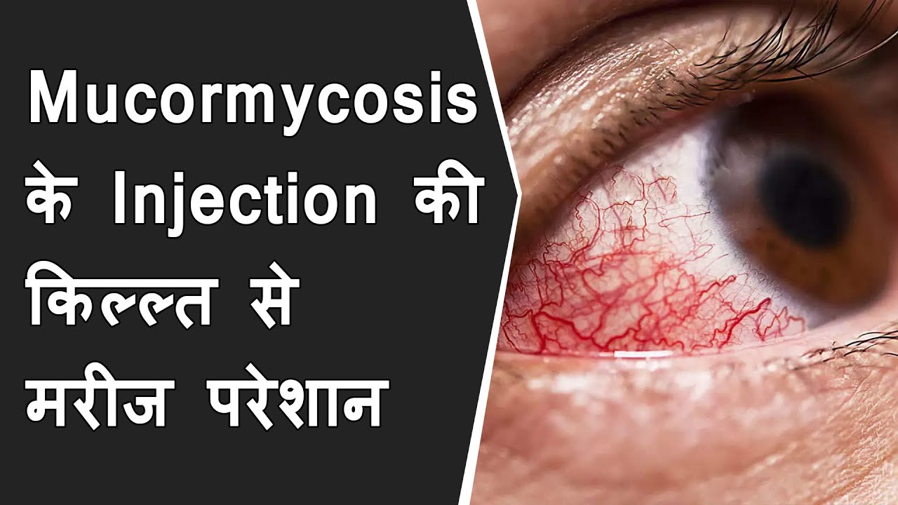 Mucormycosis के Injection की किल्ल्त से मरीज परेशान | Shortage of mucormycosis injection in gujarat