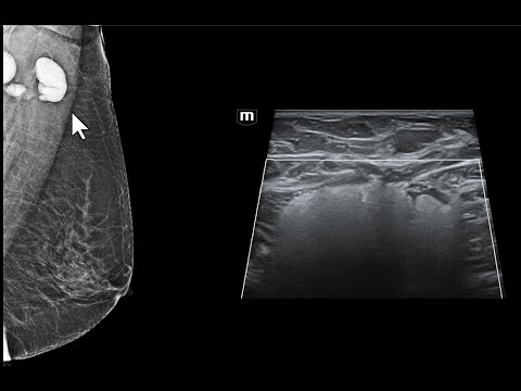 Impregnação de linfonodos axilares por silicone. Achados da mamografia e da ultrassonografia.