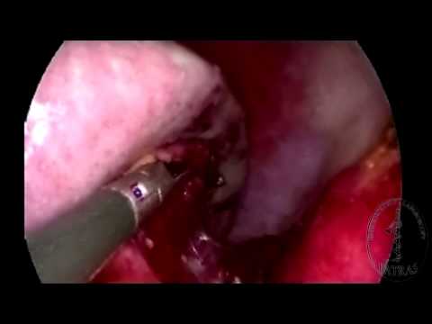 Single-Port Nephrectomy - Spleen Mobilization