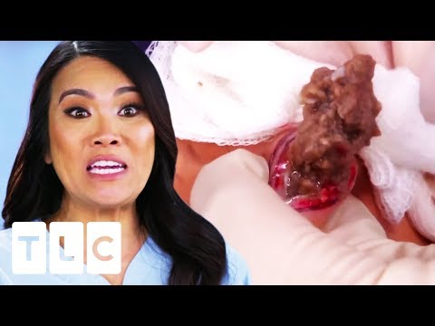"It's Like Ground Beans!" | Dr. Pimple Popper