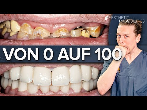 Totale Restauration im Ober- und Unterkiefer nach Zähneknirschen und Arbeitsunfall