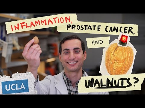 Calcificazione prostata tumore