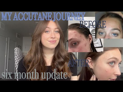 MY ACCUTANE JOURNEY: six month update