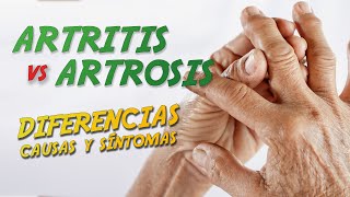 DIFERENCIA entre ARTROSIS y ARTRITIS [Causas y síntomas]