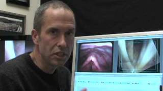 What is vocal cord paralysis? Part 2