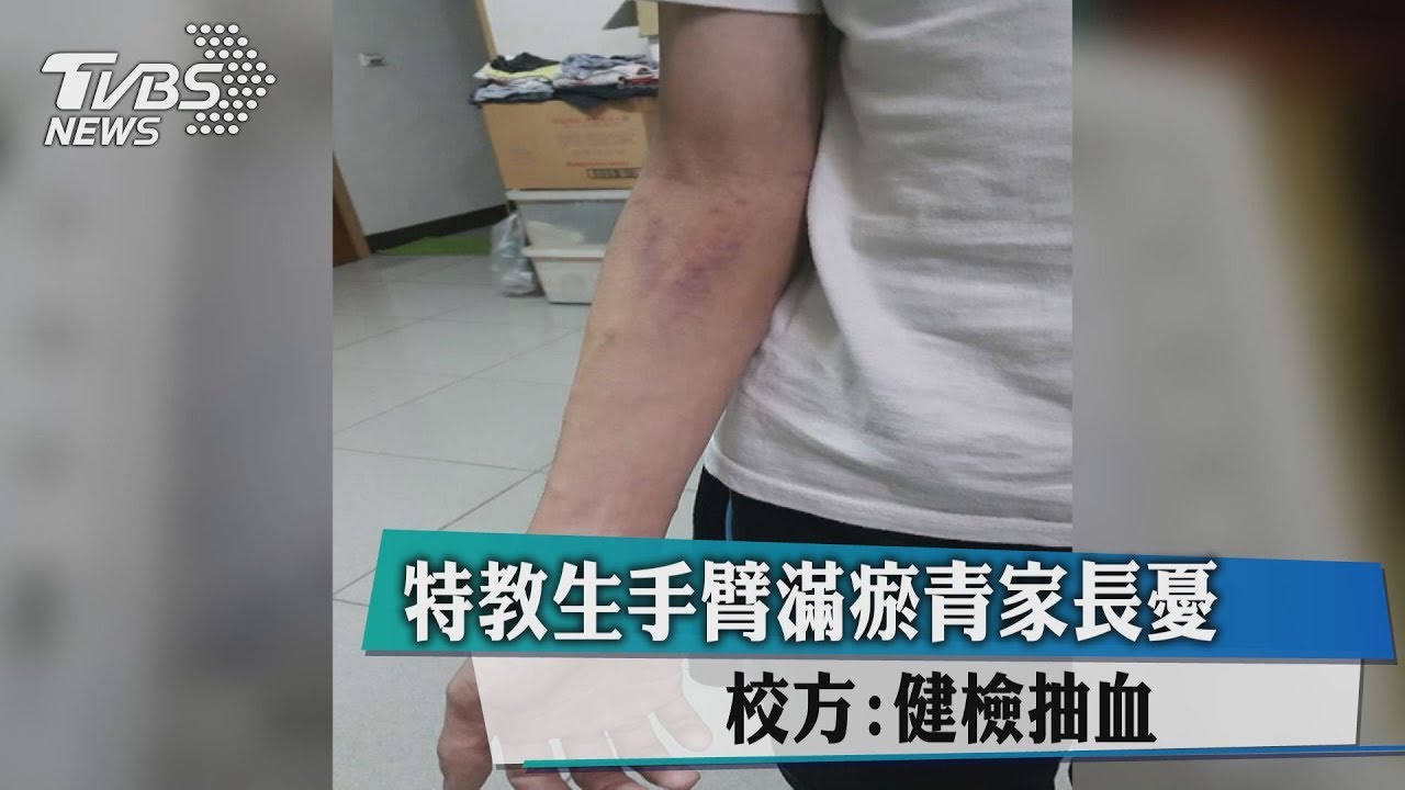 特教生手臂滿瘀青家長憂 校方:健檢抽血