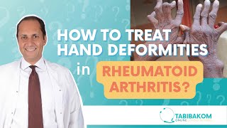 How To Treat Hand Deformities In Rheumatoid Arthritis? Dr. Hatem Eleishi