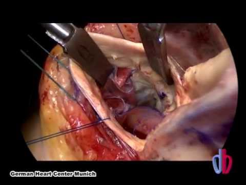 Aortic Valve Reconstruction Using Autologous Pericardium