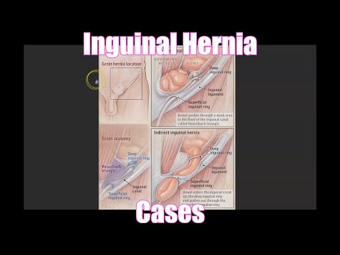 Inguinal Hernia Cases
