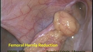 Hernia Femoral TAPP / Suture Mesh Fixation + V-Lock