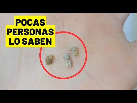COMO EXPULSAR LAS PIEDRAS DE LOS RIÑONES FÁCILMENTE (cálculos renales)