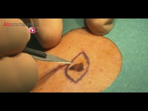 download lagu mp3 mp4 Grain Beaut Cancer, download lagu Grain Beaut Cancer gratis, unduh video klip Grain Beaut Cancer