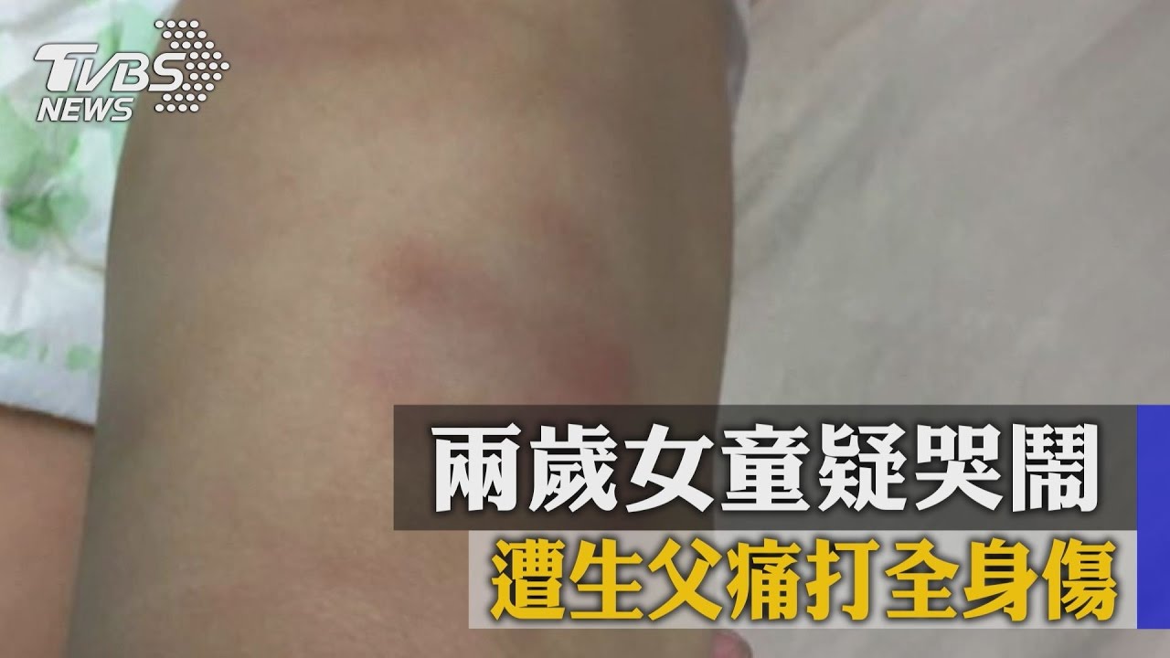 兩歲女童疑哭鬧 遭生父痛打全身傷