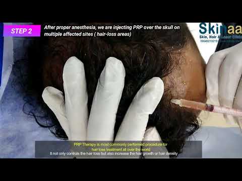 PRP Therapy with dermaroller for hair loss treatment & re-growth | Skinaa Clinic