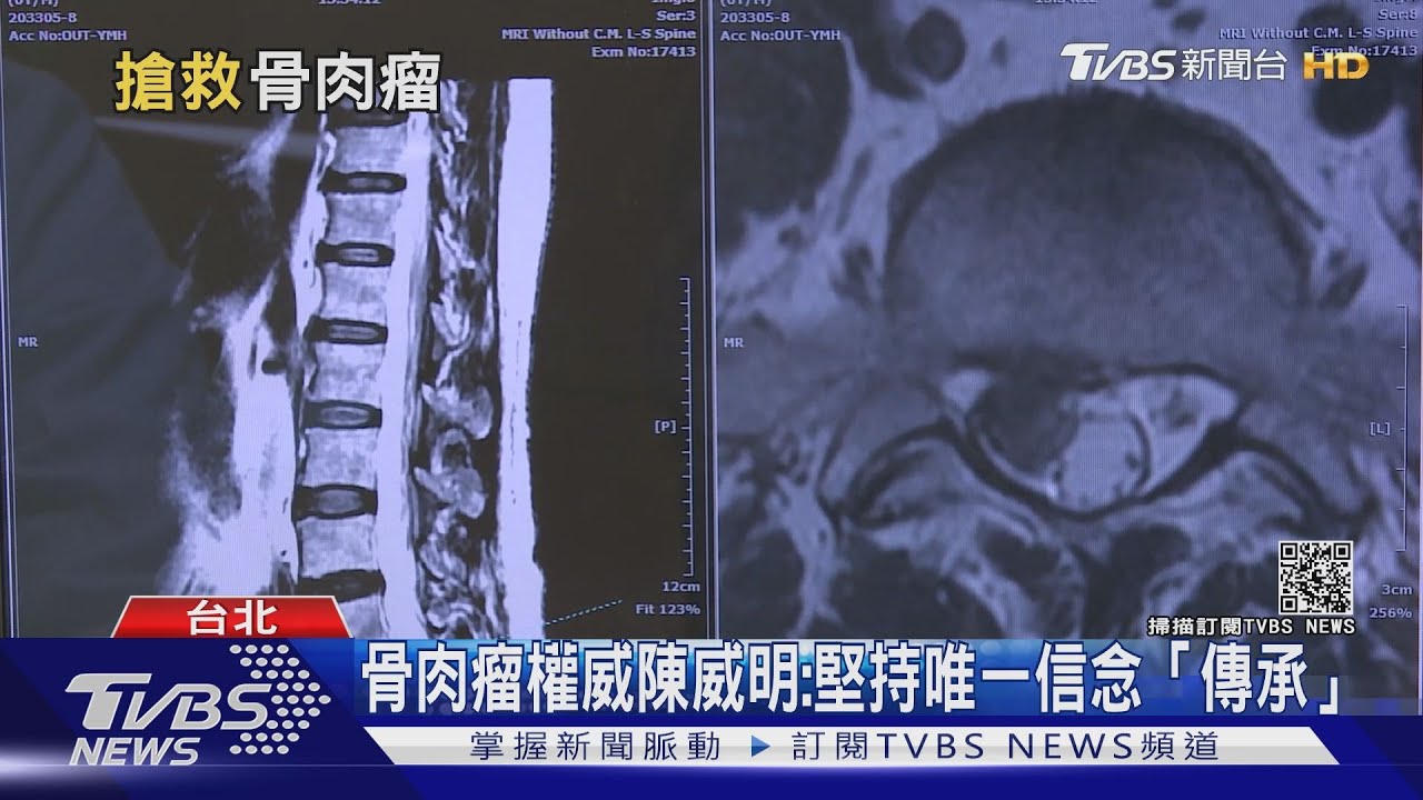 北榮搶救「骨肉瘤」少女　突破全球關鍵技術是這件事！