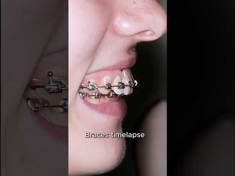 Braces fix gummy smile and overbite teeth #braces #orthodontist #dentist