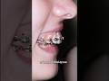 Braces fix gummy smile and overbite teeth #braces #orthodontist #dentist