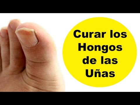 Que ayuda del hongo sobre la uña del pie